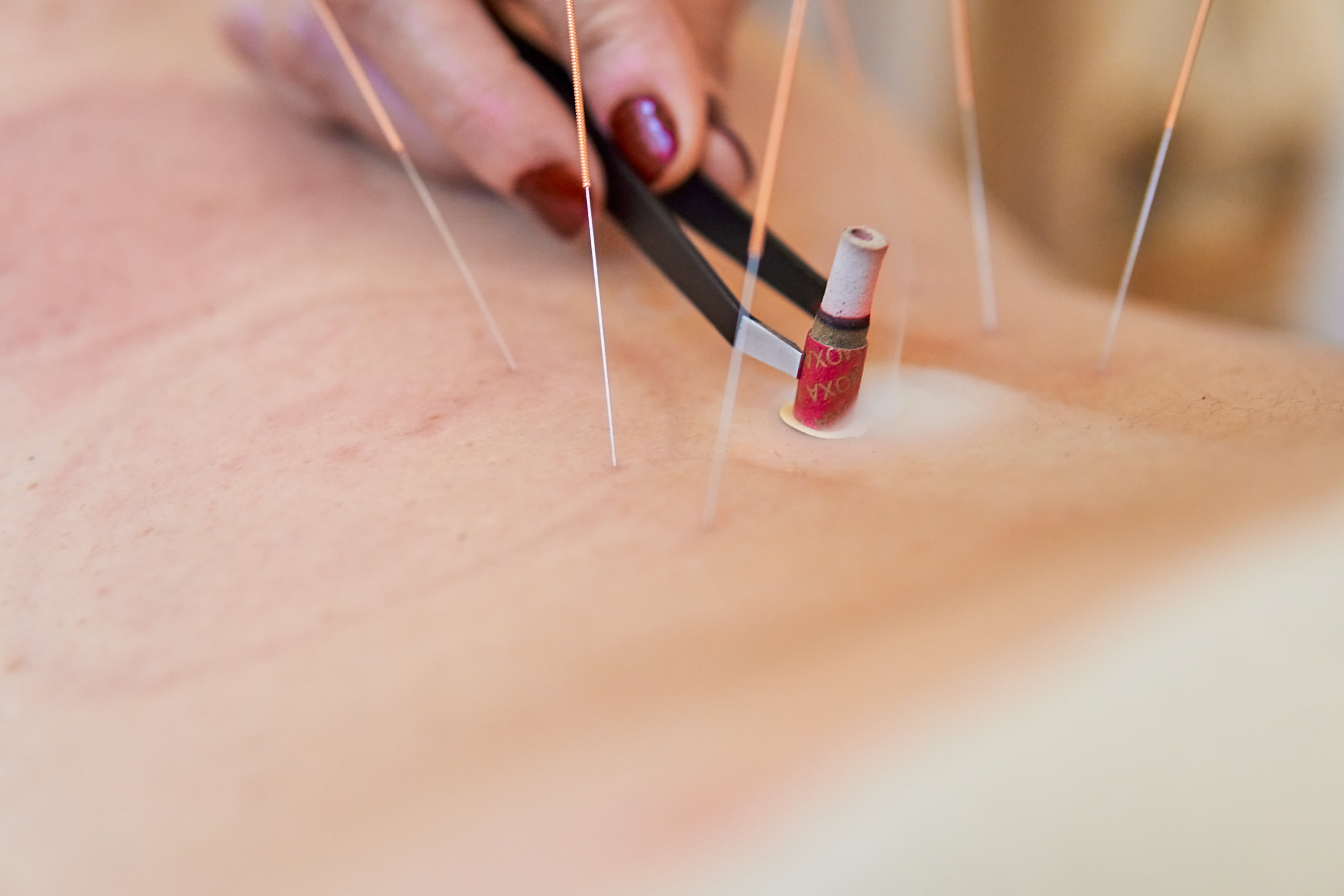 Acupuncture Image